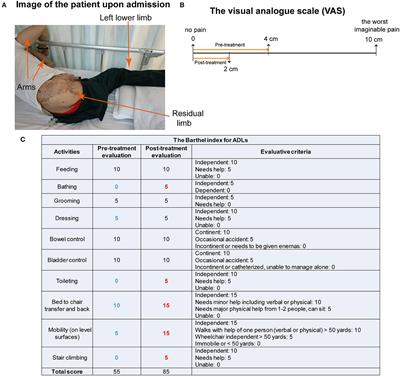Case report: A combination of mirror therapy and magnetic stimulation to the sacral plexus relieved phantom limb pain in a patient